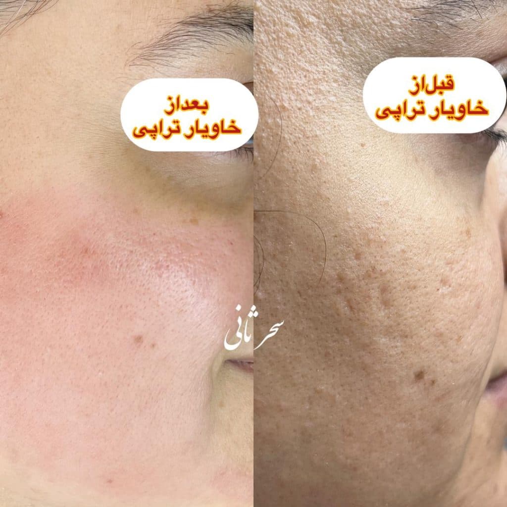 ریمو و تتوی صورت سحر ثانی رشت