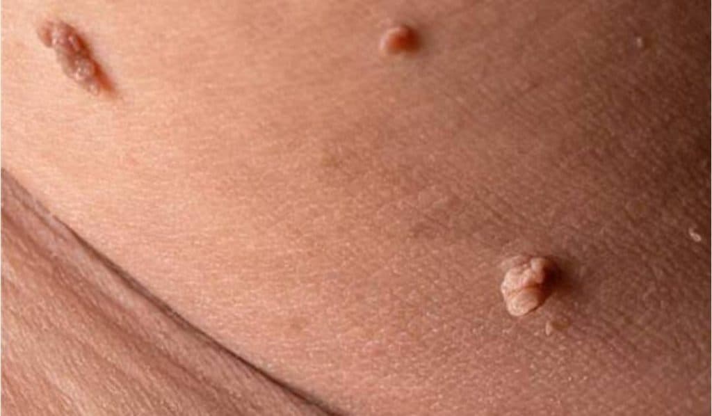 درمان زگیل تناسلی نسا در خرم آباد