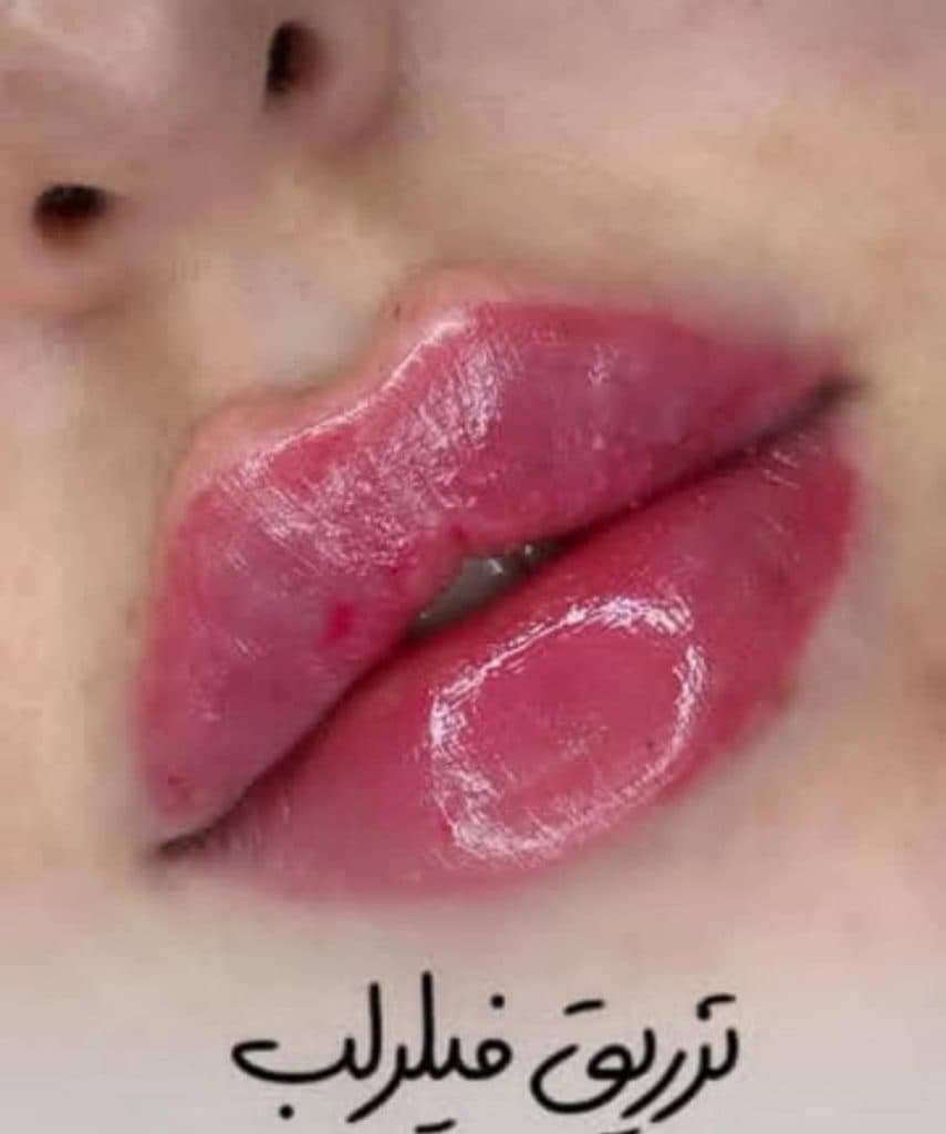 مرکز تخصصی تزریق ژل لب دکتر پوریا پورسهرابی کرمان