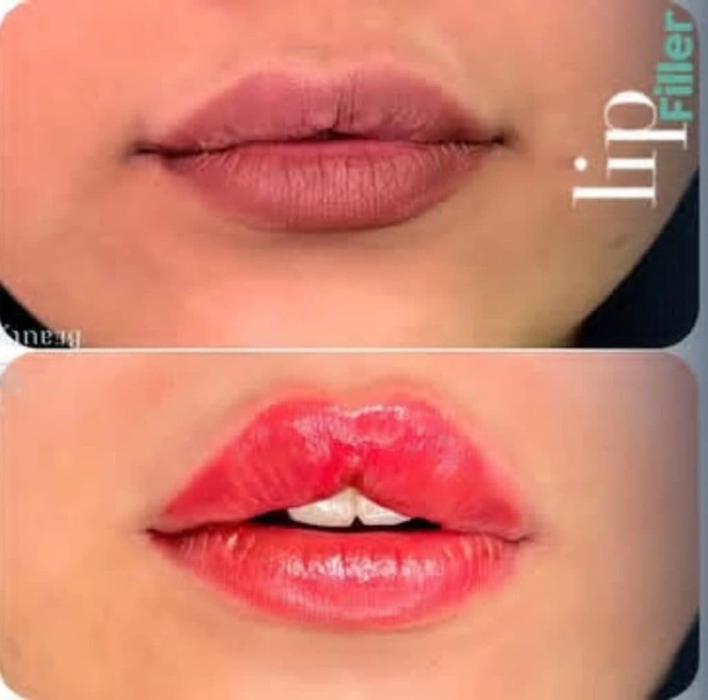 مرکز تخصصی تزریق ژل لب دکتر پوریا پورسهرابی کرمان