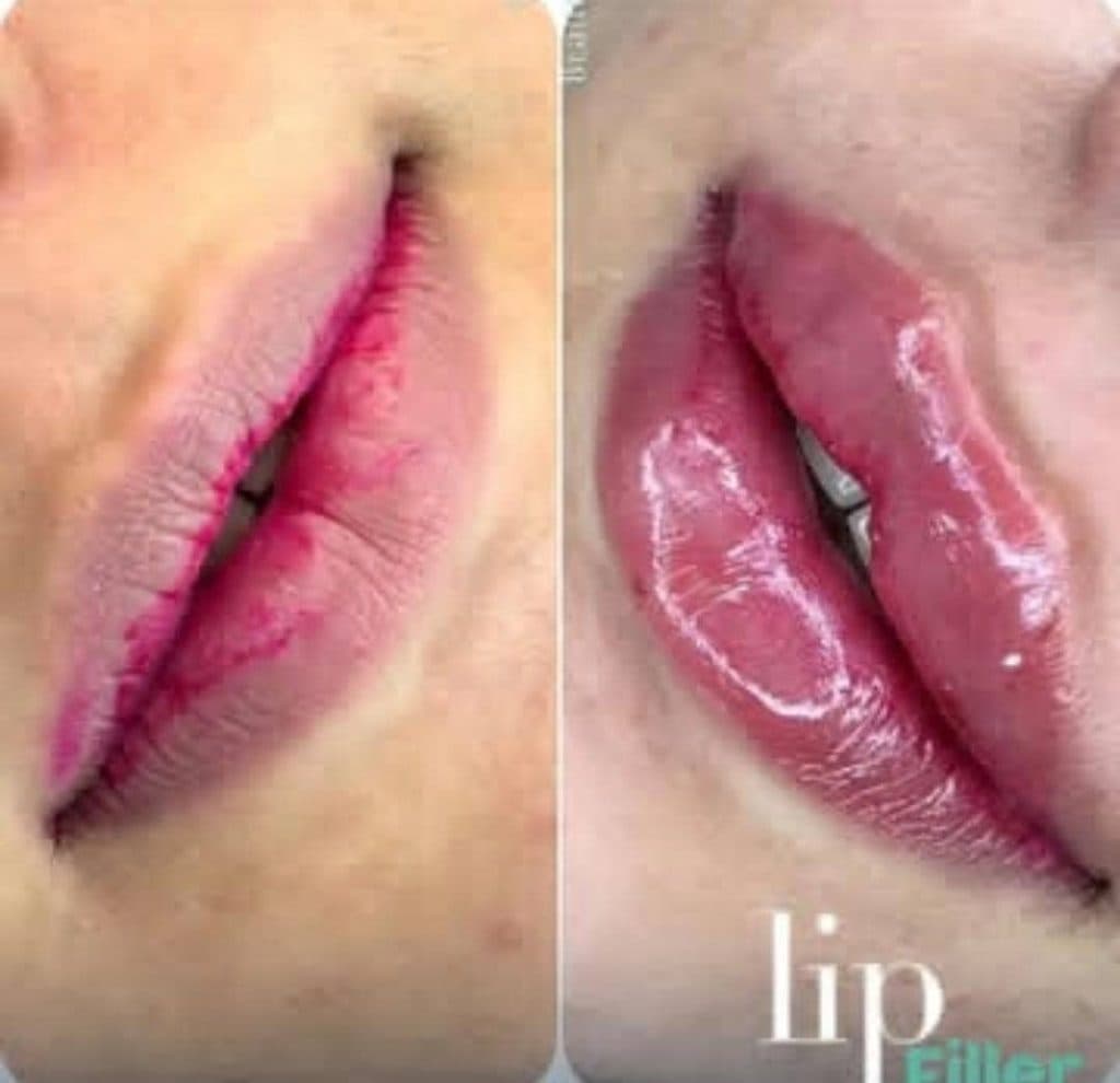 مرکز تخصصی تزریق ژل لب دکتر پوریا پورسهرابی کرمان