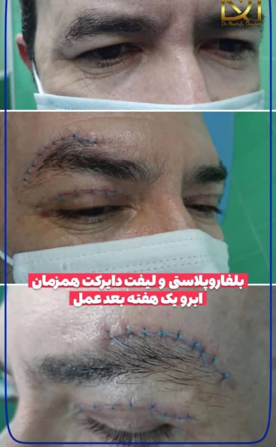 جراحی بلفاروپلاستی پلک بالا و پایین دکتر مصطفی دوستانی تبریز