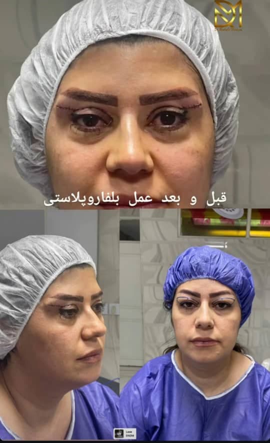 جراحی بلفاروپلاستی پلک بالا و پایین دکتر مصطفی دوستانی تبریز