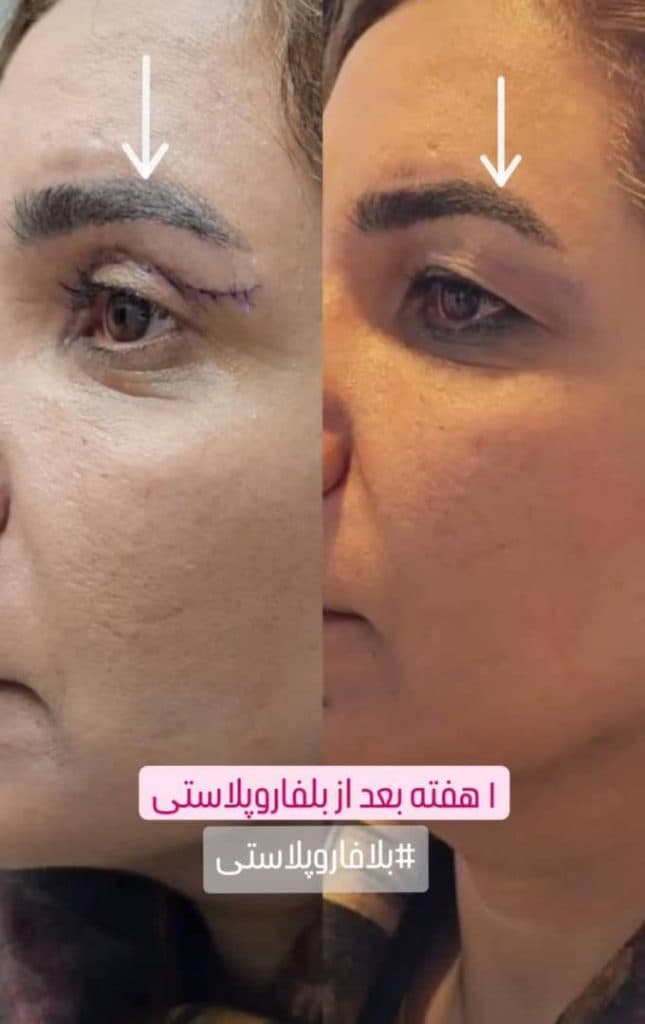 جراحی بلفاروپلاستی پلک بالا و پایین دکتر مصطفی دوستانی تبریز