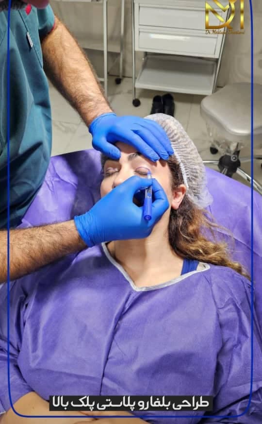 جراحی بلفاروپلاستی پلک بالا و پایین دکتر مصطفی دوستانی تبریز