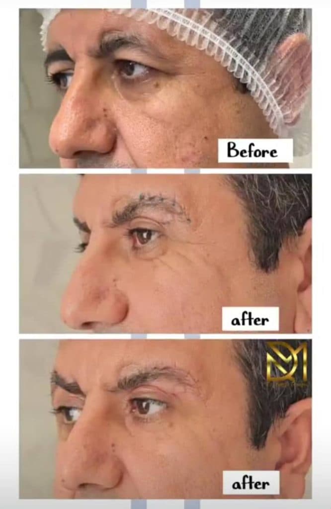 جراحی بلفاروپلاستی پلک بالا و پایین دکتر مصطفی دوستانی تبریز