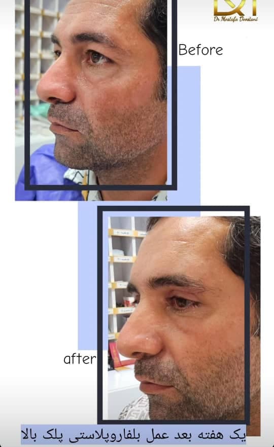 جراحی بلفاروپلاستی پلک بالا و پایین دکتر مصطفی دوستانی تبریز