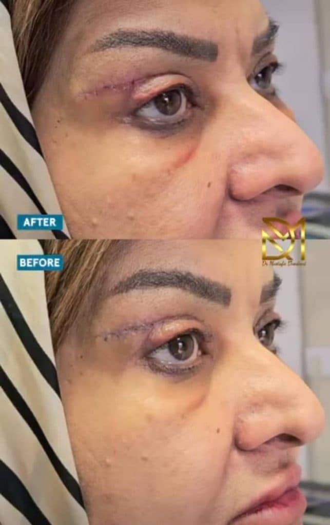 جراحی بلفاروپلاستی پلک بالا و پایین دکتر مصطفی دوستانی تبریز