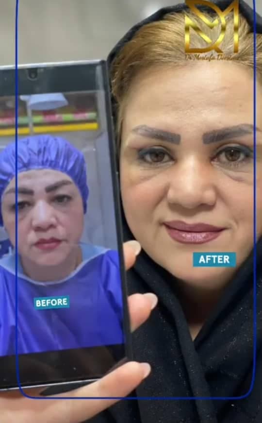 جراحی بلفاروپلاستی پلک بالا و پایین دکتر مصطفی دوستانی تبریز