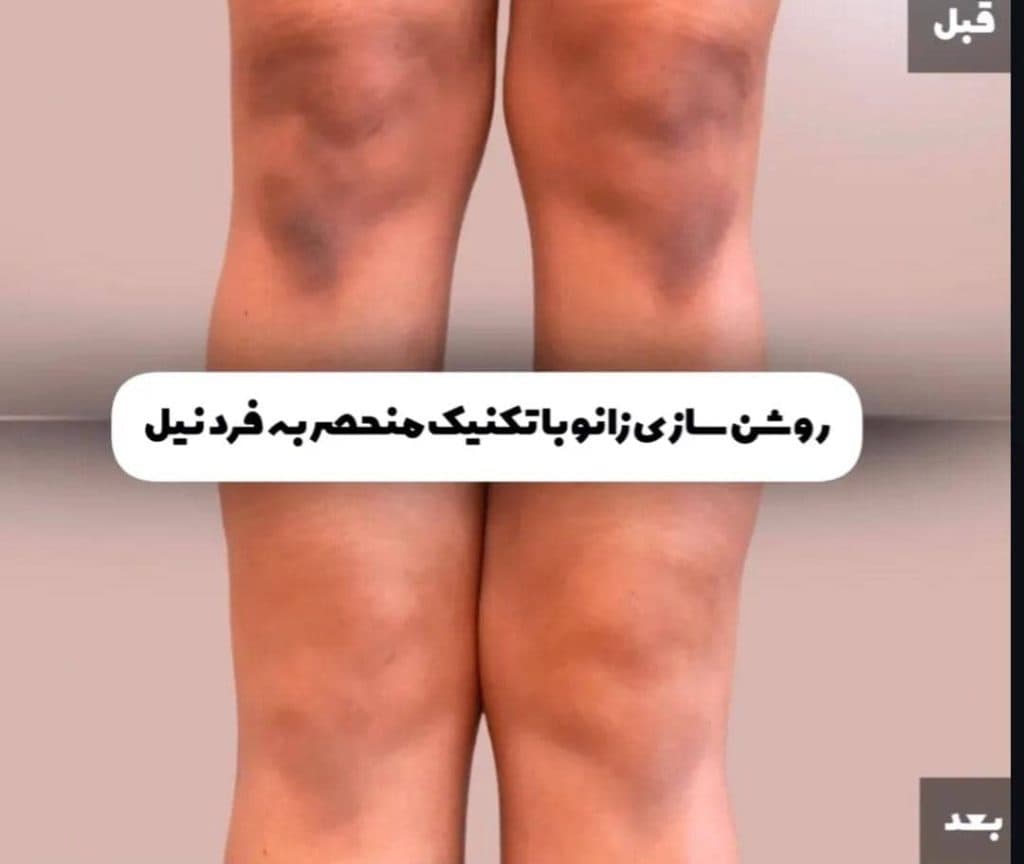 مرکز تخصصی روشن سازی بدن با لیزر نایس قاعدی رفسنجان