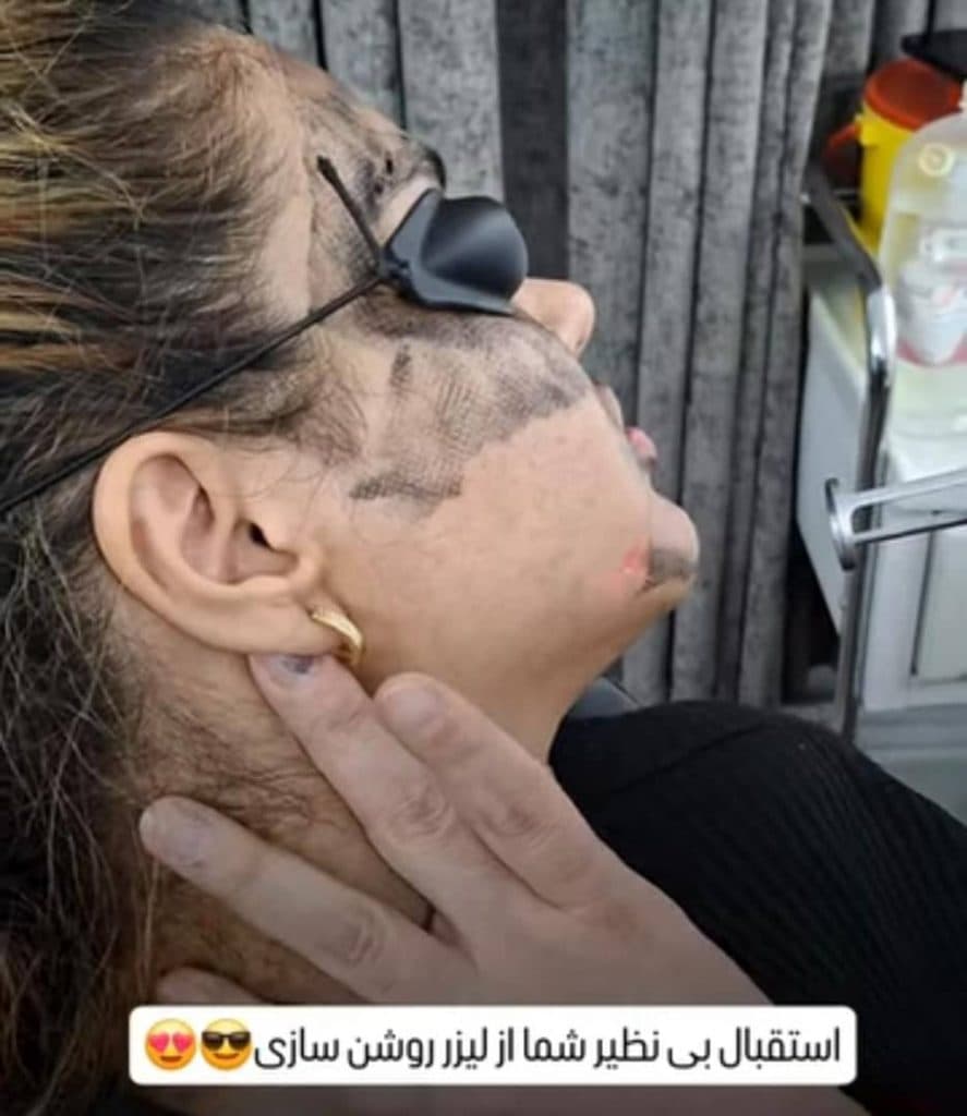 مرکز تخصصی لیزر موهای زائد نایس قاعدی رفسنجان