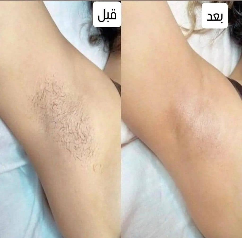 مرکز تخصصی روشن سازی بدن با لیزر نایس قاعدی رفسنجان