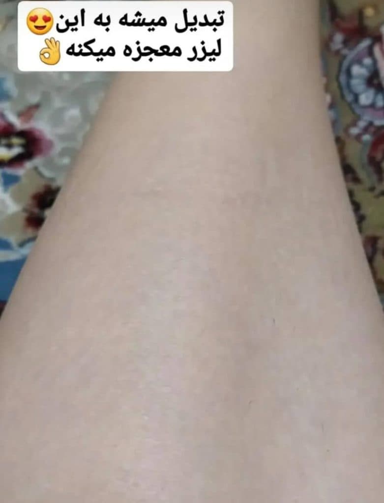 مرکز تخصصی لیزر موهای زائد نایس قاعدی رفسنجان