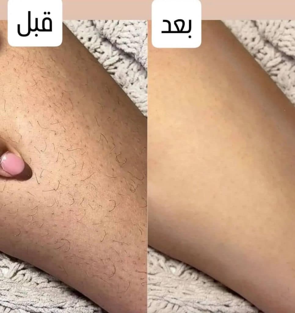 مرکز تخصصی لیزر موهای زائد نایس قاعدی رفسنجان