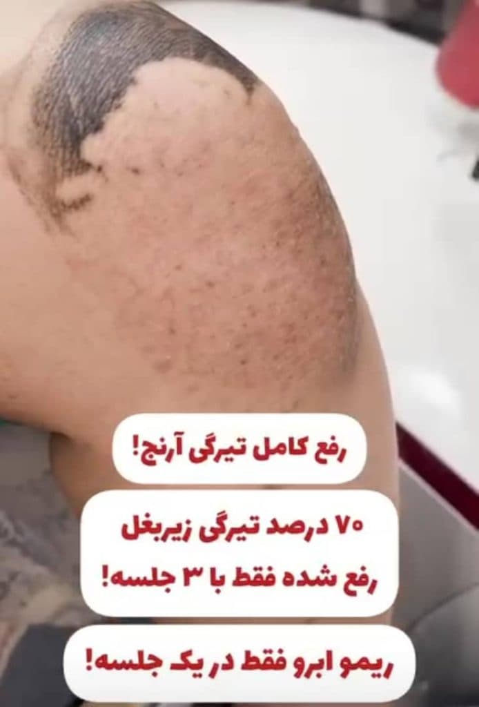 مرکز تخصصی روشن سازی بدن با لیزر نایس قاعدی رفسنجان