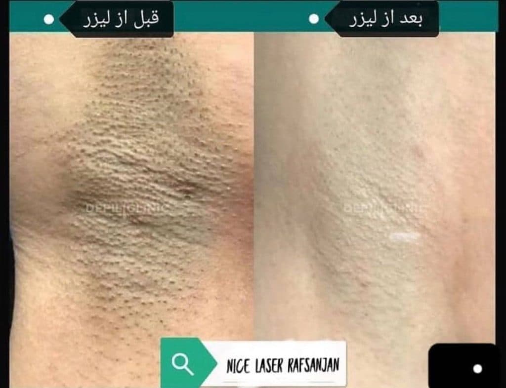 مرکز تخصصی روشن سازی بدن با لیزر نایس قاعدی رفسنجان