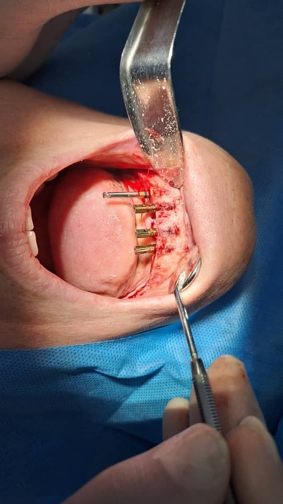مرکز تخصصی ایمپلنت دندان دکتر مصطفی آلام تهرانپارس تهران