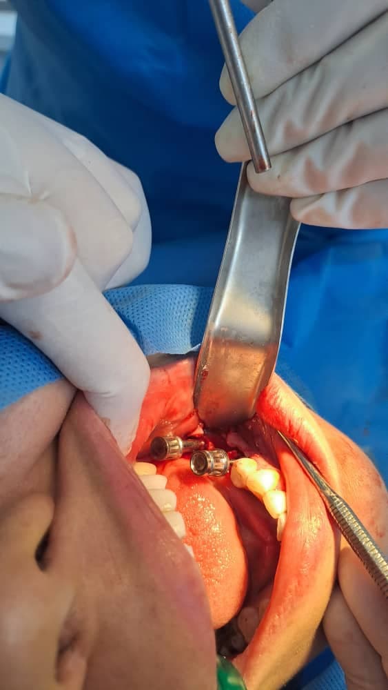 مرکز تخصصی ایمپلنت دندان دکتر مصطفی آلام تهرانپارس تهران