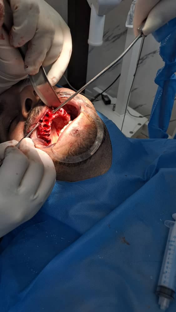 مرکز تخصصی ایمپلنت دندان دکتر مصطفی آلام تهرانپارس تهران