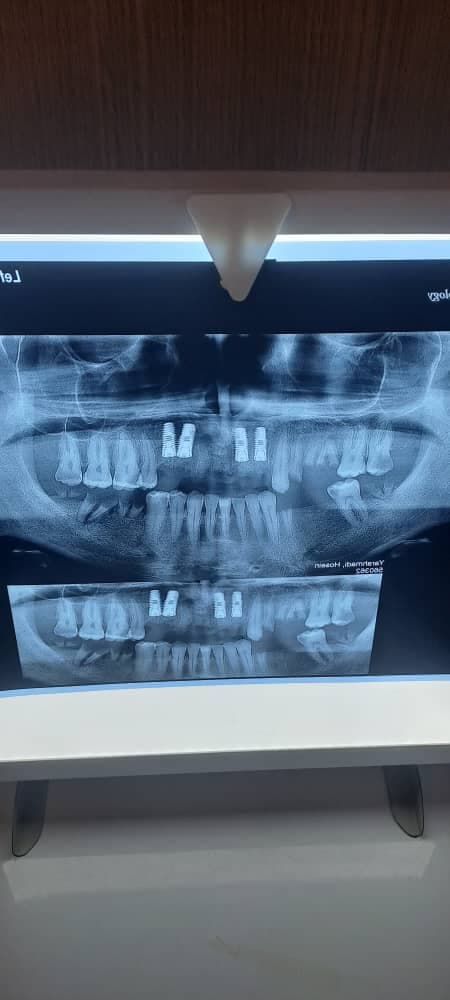 مرکز تخصصی ایمپلنت دندان دکتر مصطفی آلام تهرانپارس تهران