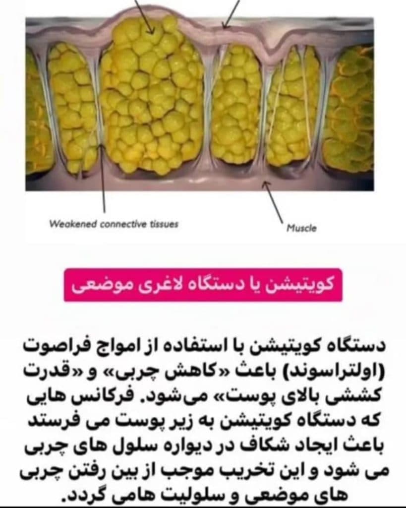 خدمات لاغری موضعی لاریسا اسلیمینگ در شرق تهران