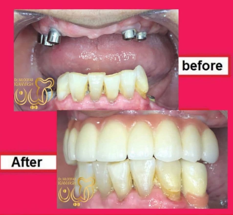 مرکز ایمپلنت سرو در سعادت آباد تهران