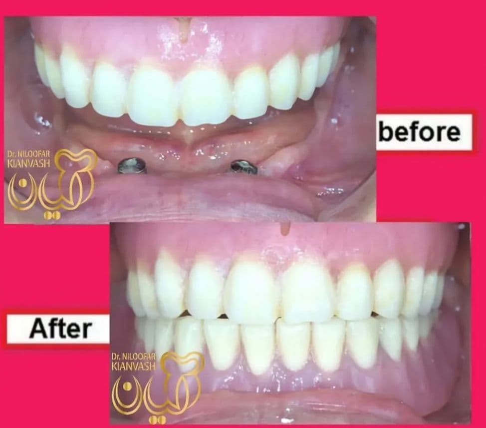 مرکز ایمپلنت سرو در سعادت آباد تهران