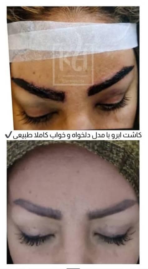 کلینیک تخصصی کاشت مو و ابرو هاشمی در تبریز