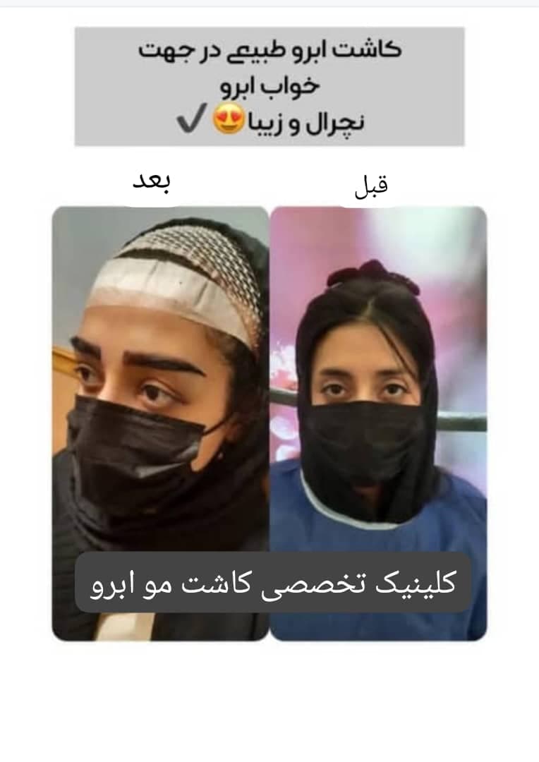 کلینیک تخصصی کاشت مو و ابرو هاشمی در تبریز