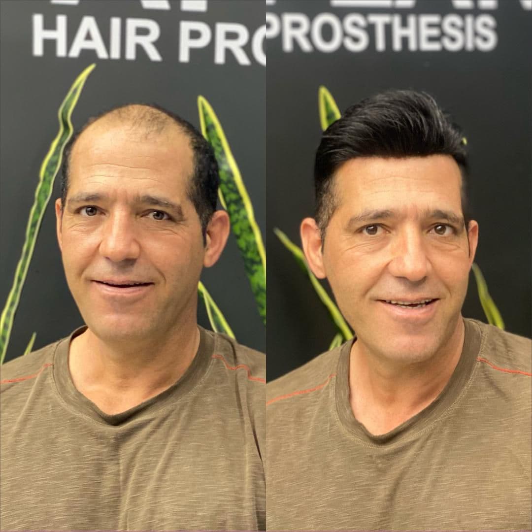 خدمات پروتز مو و میکروبلیدینگ با استایل مردانه محمد افلاک در قزوین