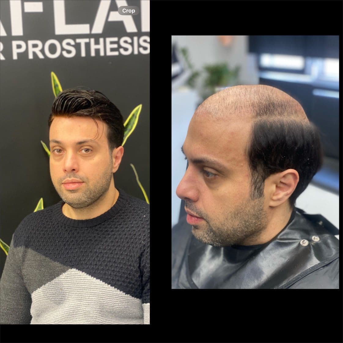 خدمات پروتز مو و میکروبلیدینگ با استایل مردانه محمد افلاک در قزوین