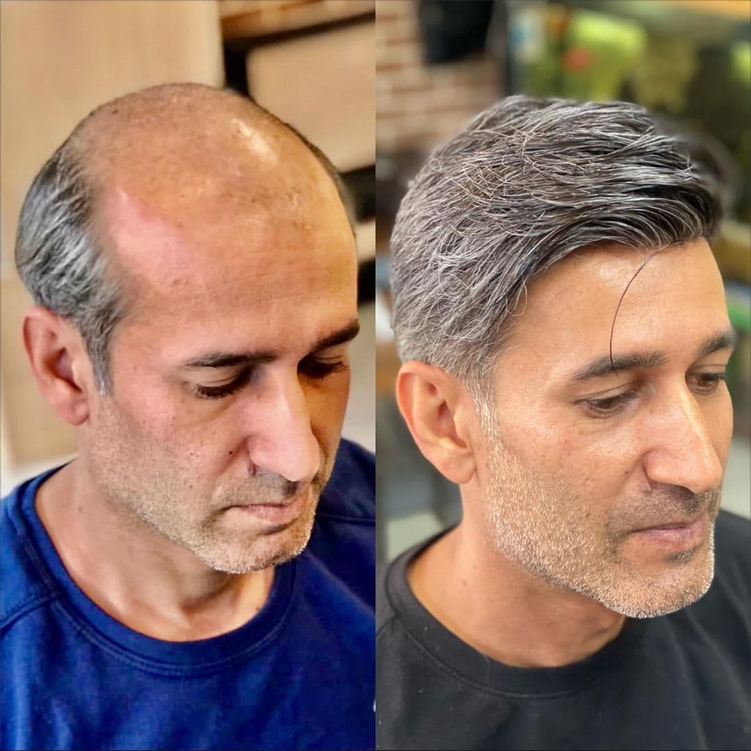 خدمات پروتز مو و میکروبلیدینگ با استایل مردانه محمد افلاک در قزوین