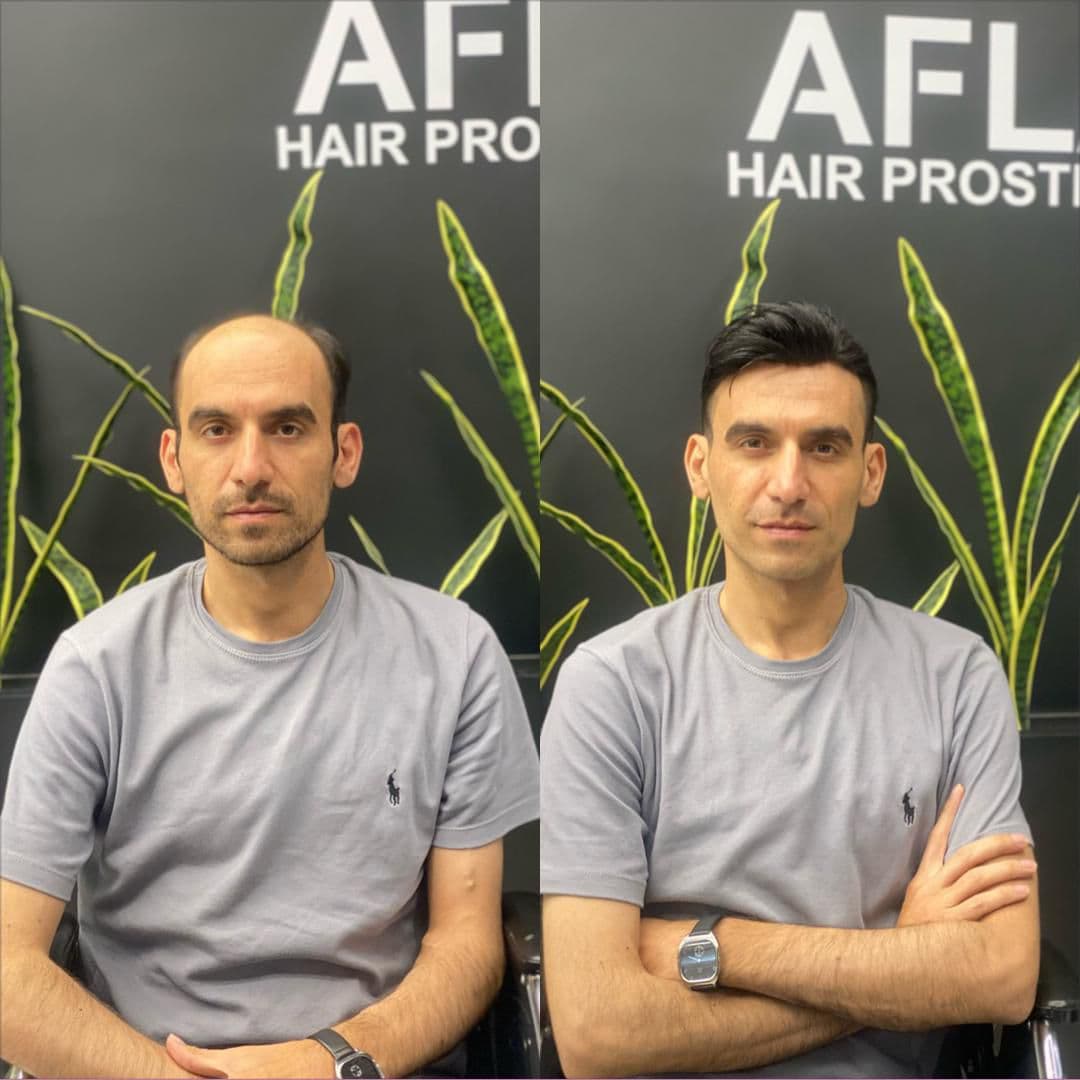 خدمات پروتز مو و میکروبلیدینگ با استایل مردانه محمد افلاک در قزوین