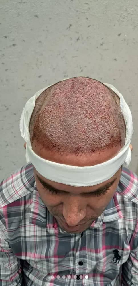 کلینیک تخصصی کاشت مو و ابرو هاشمی در تبریز