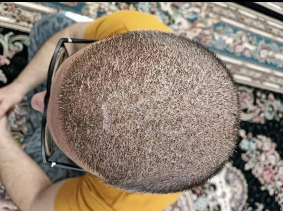 کلینیک تخصصی کاشت مو و ابرو هاشمی در تبریز