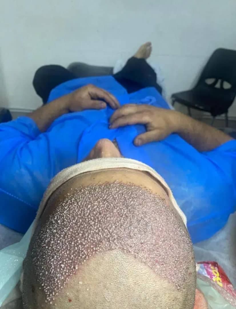 کلینیک تخصصی کاشت مو و ابرو هاشمی در تبریز