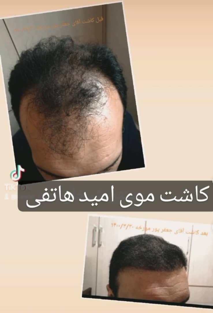 مجموعه کاشت مو و ریش هاتفی در تبریز