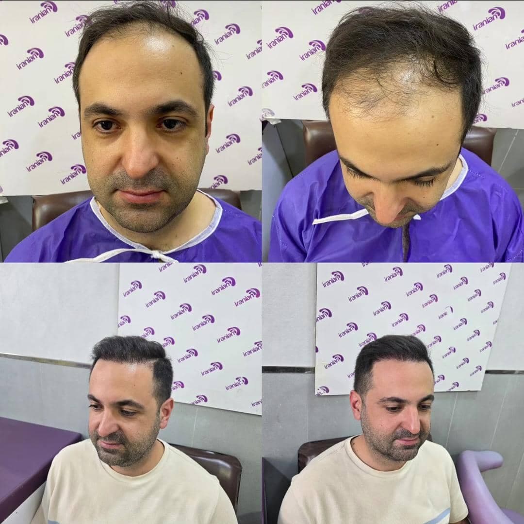 مجموعه کاشت مو و ریش هاتفی در تبریز