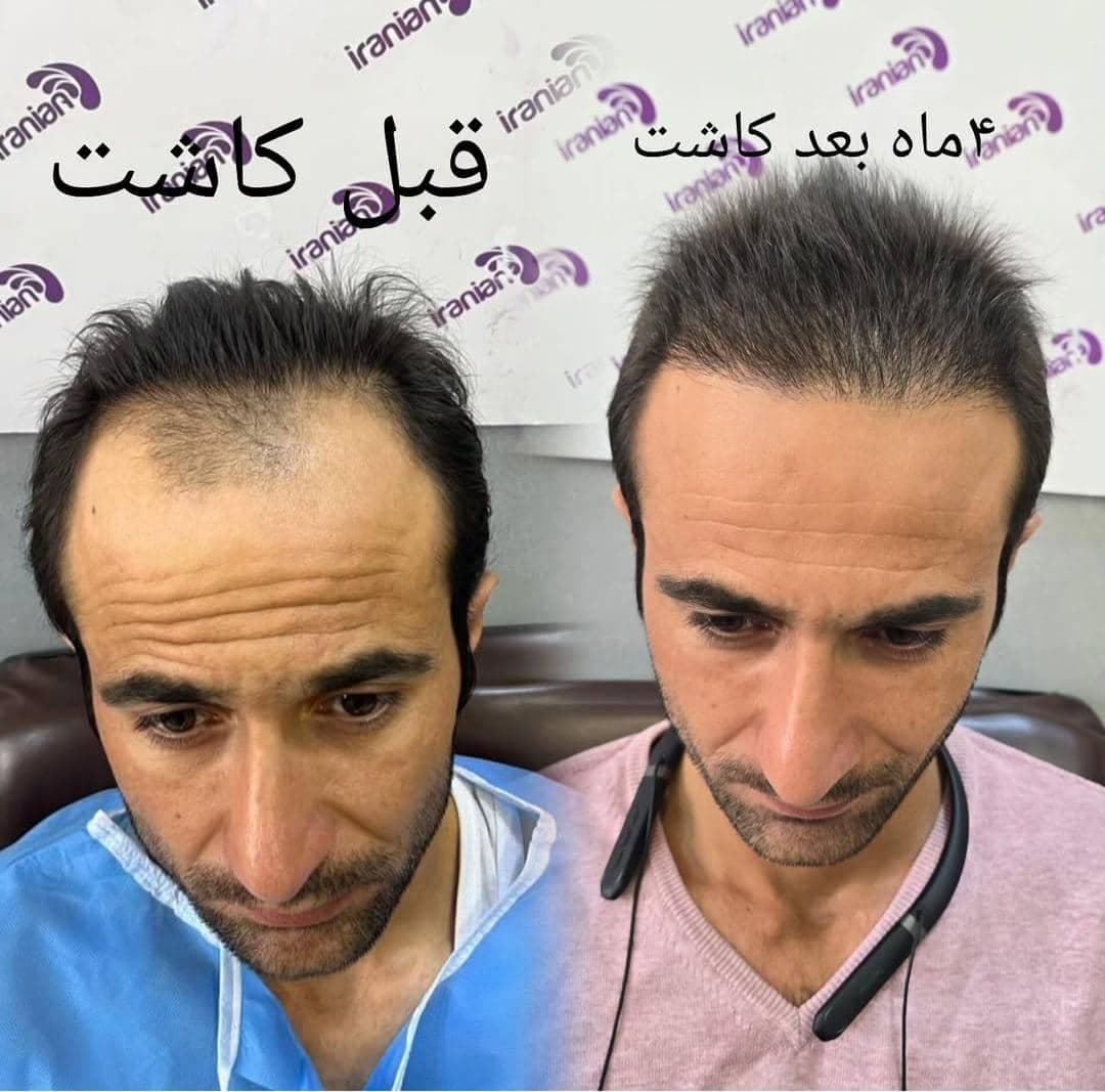 مجموعه کاشت مو و ریش هاتفی در تبریز