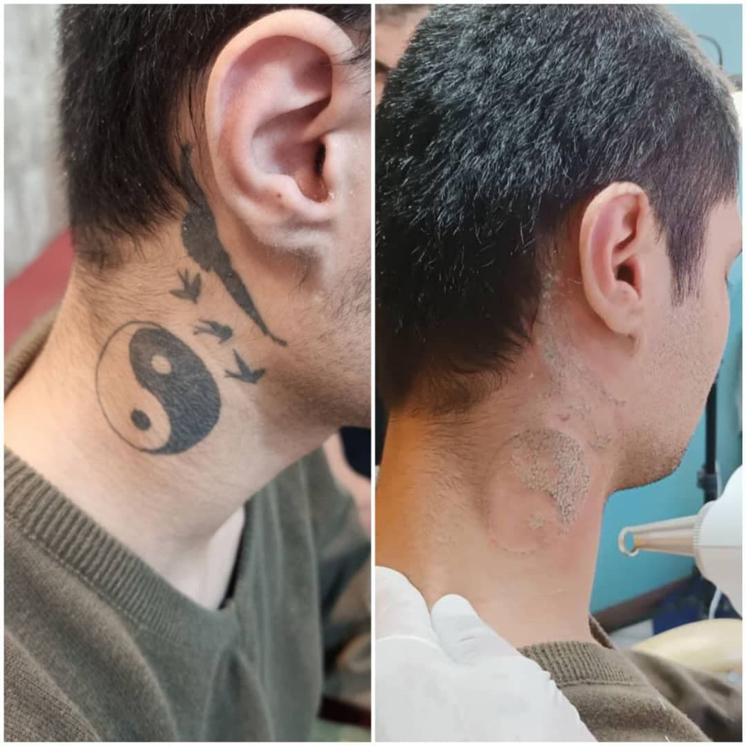 مطب تخصصی رفع ضایعات پوستی و سوراخ کردن گوش دکتر عسکری در سرگل رشت