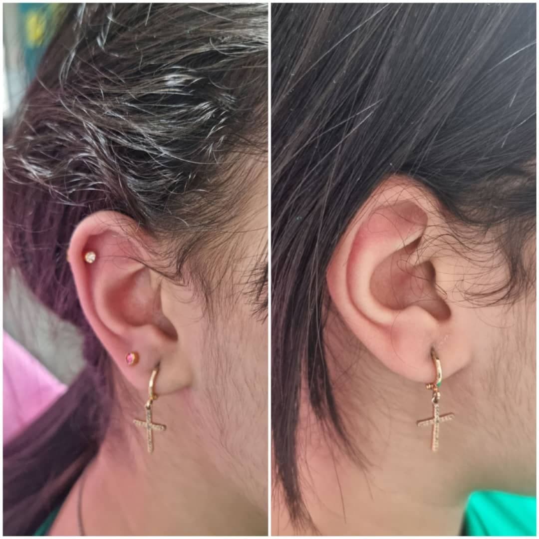 مطب تخصصی رفع ضایعات پوستی و سوراخ کردن گوش دکتر عسکری در سرگل رشت