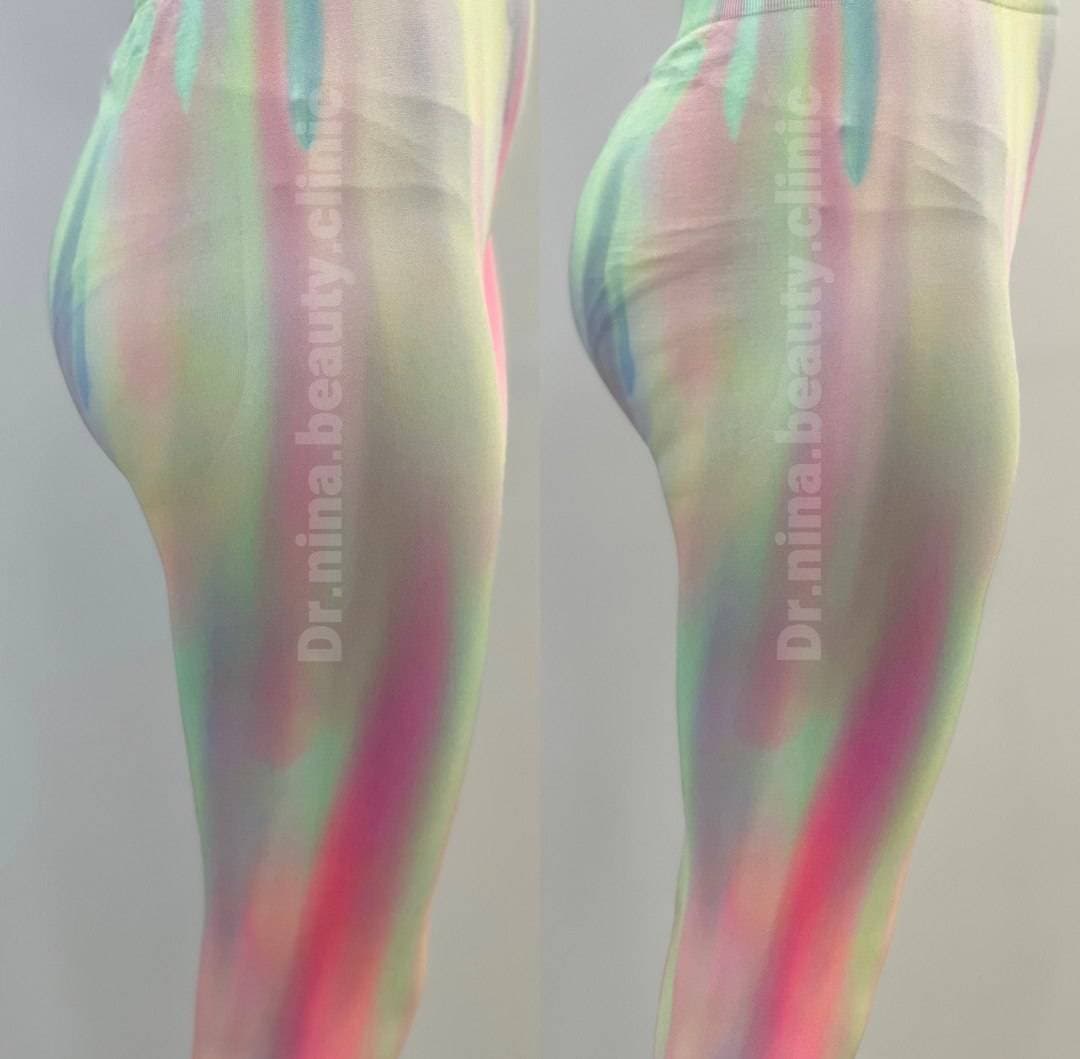 مرکز تخصصی فیلر بادی نینا در قائمشهر