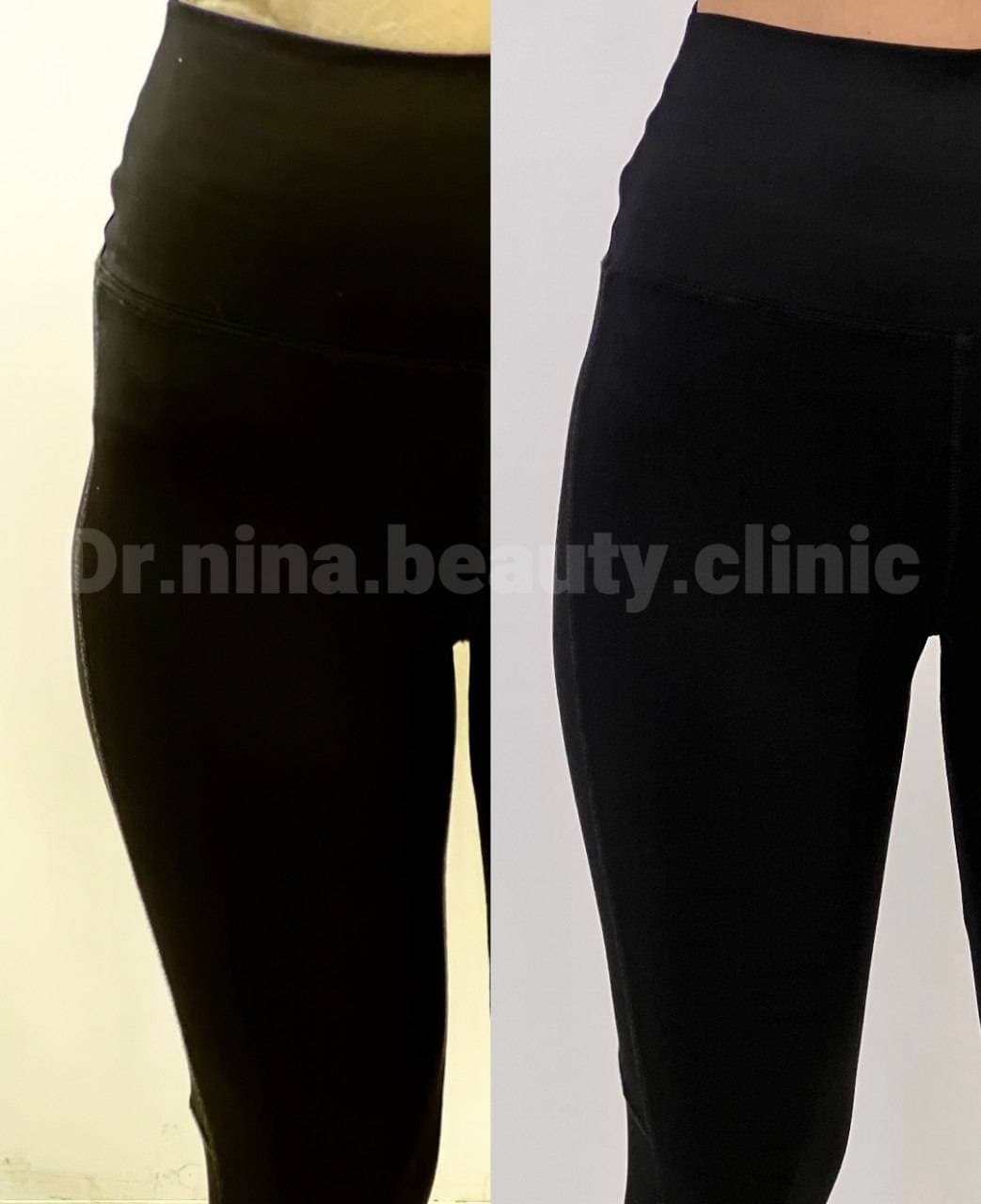 مرکز تخصصی فیلر بادی نینا در قائمشهر