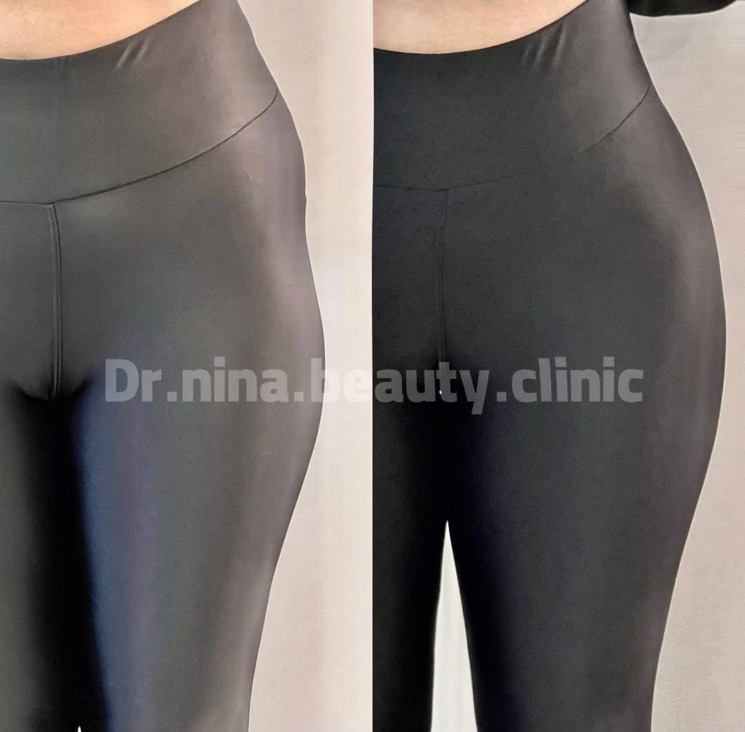 مرکز تخصصی فیلر بادی نینا در قائمشهر