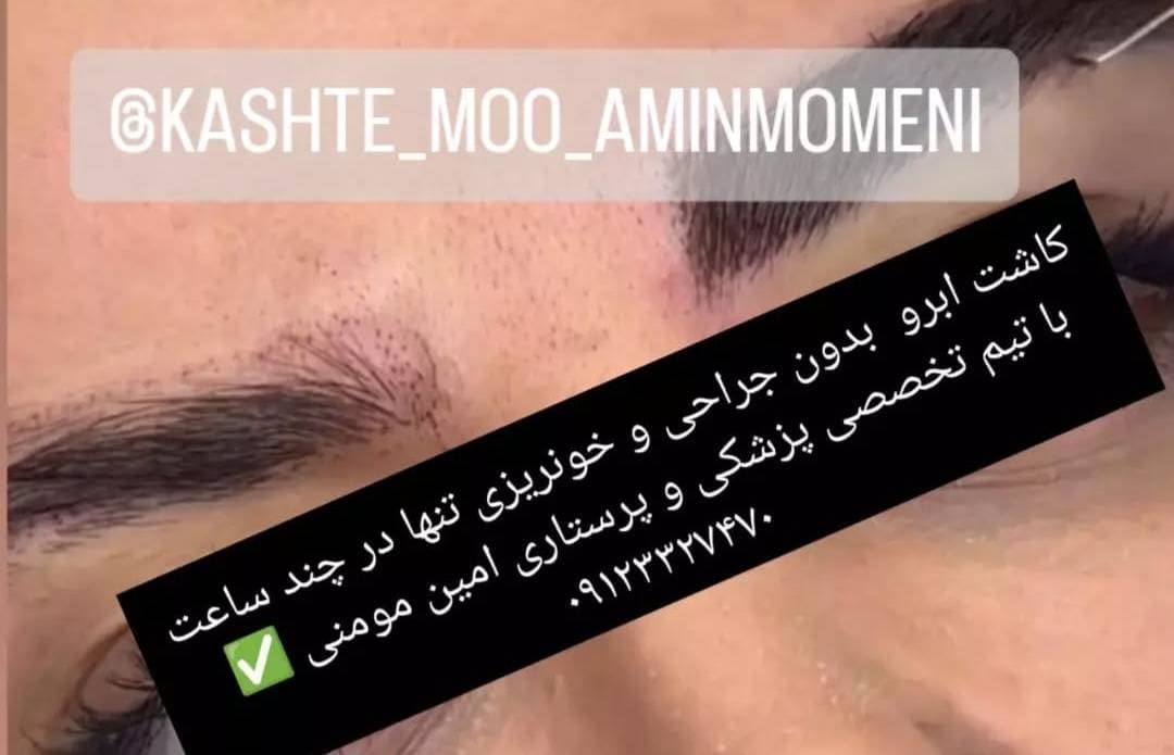 کاشت مو و ابرو امین مومنی در جنت آباد تهران