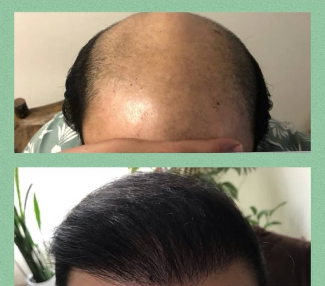 کاشت مو و ابرو امین مومنی در جنت آباد تهران