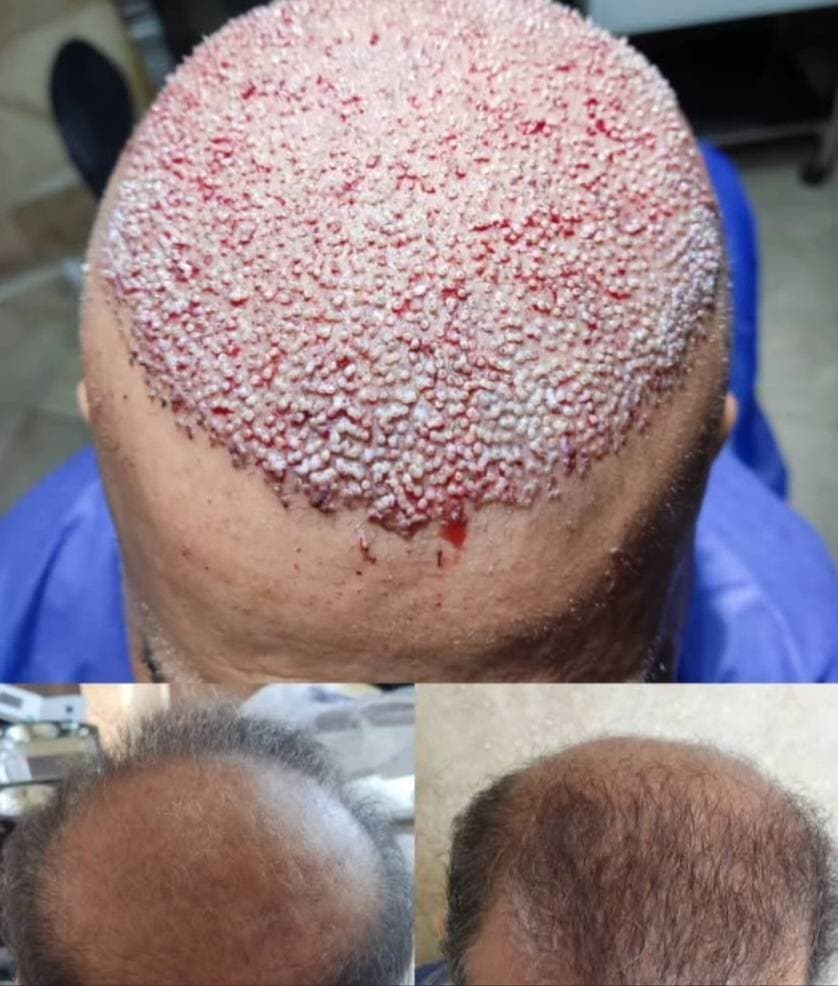 کاشت مو و ابرو امین مومنی در جنت آباد تهران