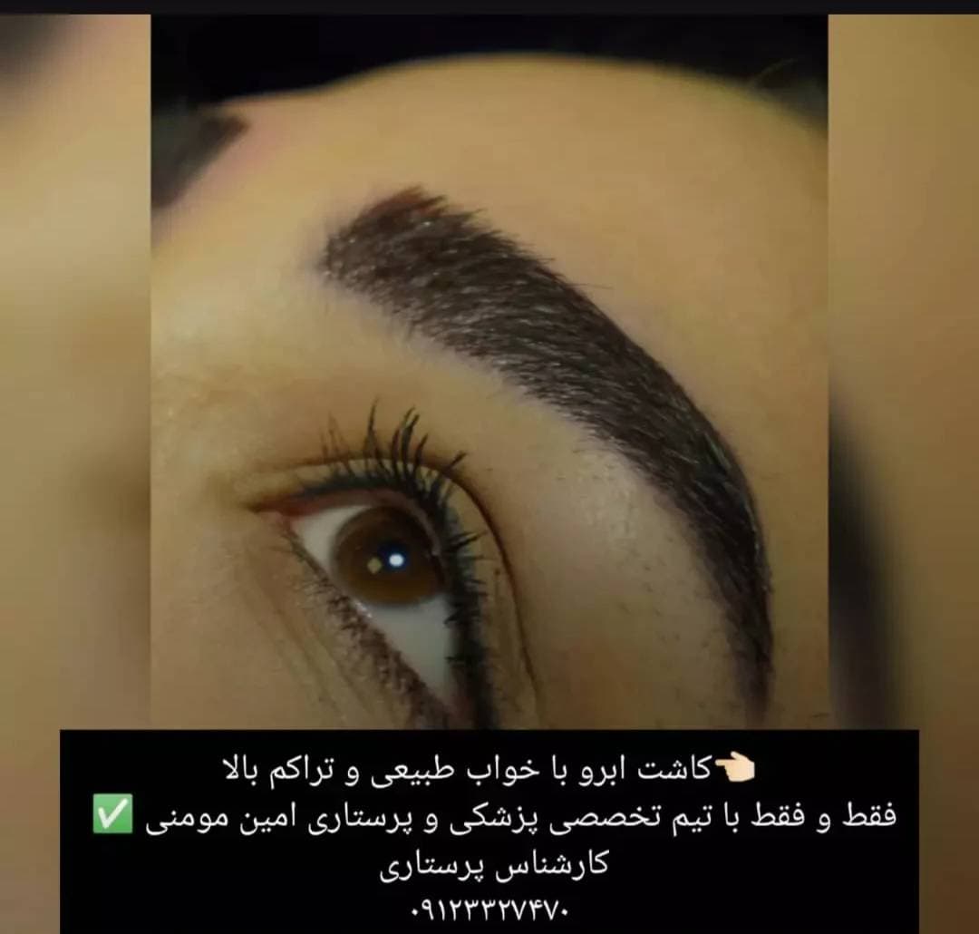 کاشت مو و ابرو امین مومنی در جنت آباد تهران