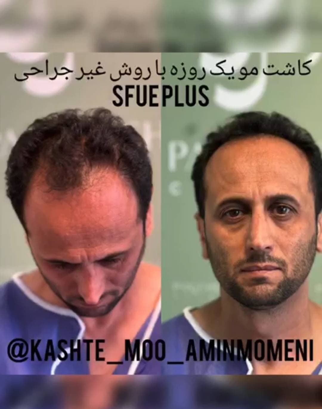 کاشت مو و ابرو امین مومنی در جنت آباد تهران