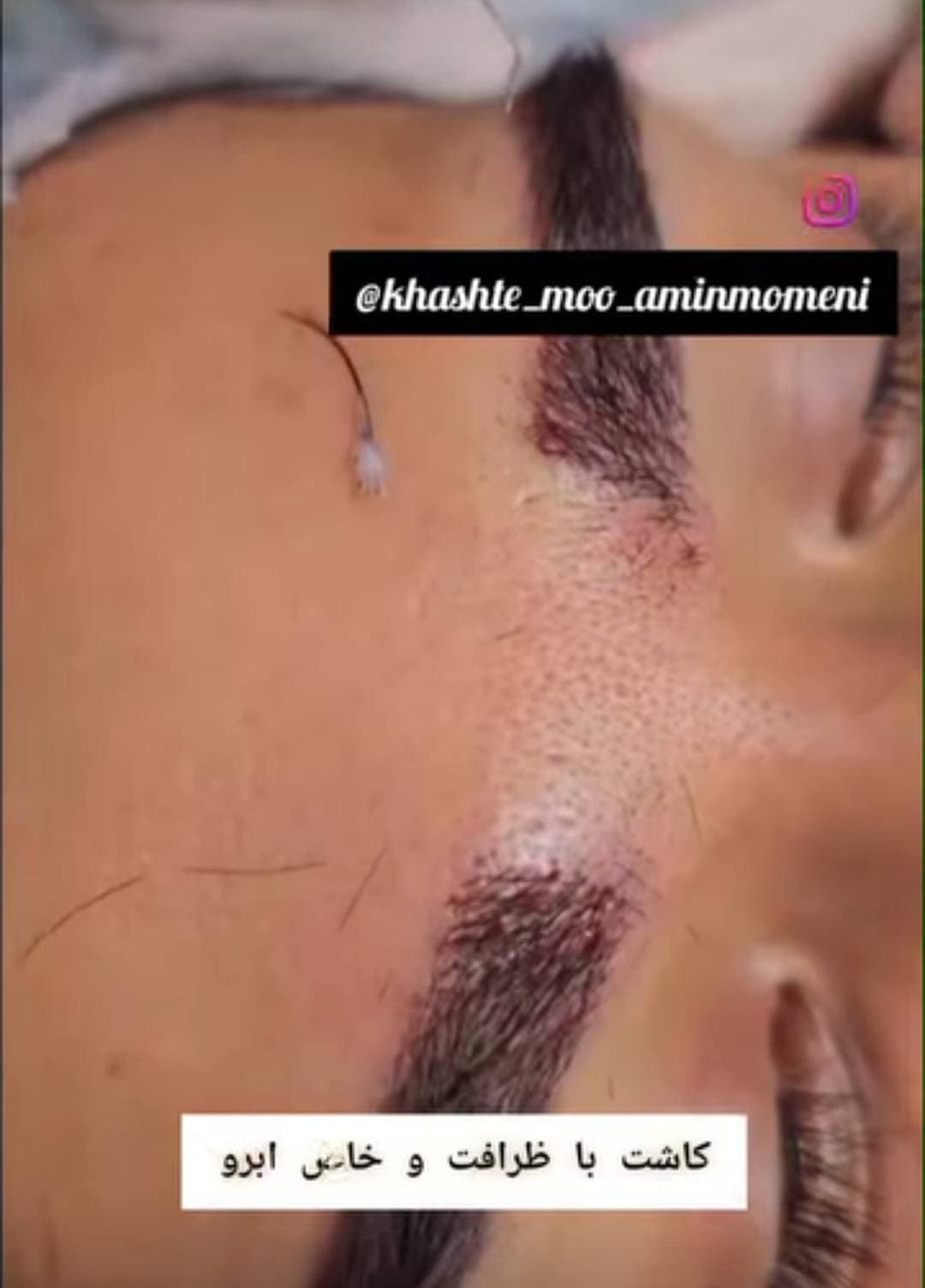 کاشت مو و ابرو امین مومنی در جنت آباد تهران